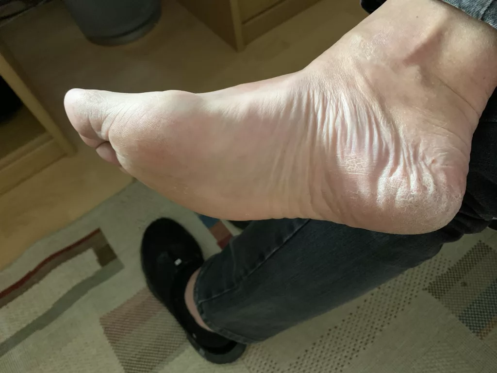 Fußmaske Test Bild 1 Meine Füße vor der Behandlung
